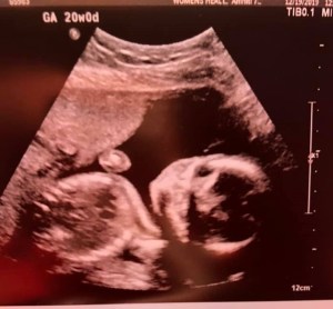 Ultrasound picture